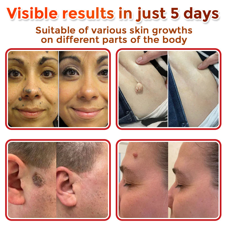 GFOUK® MicroNeedle Botanic Skin Tag Removal Patch 🇨🇦 Made in Canada
