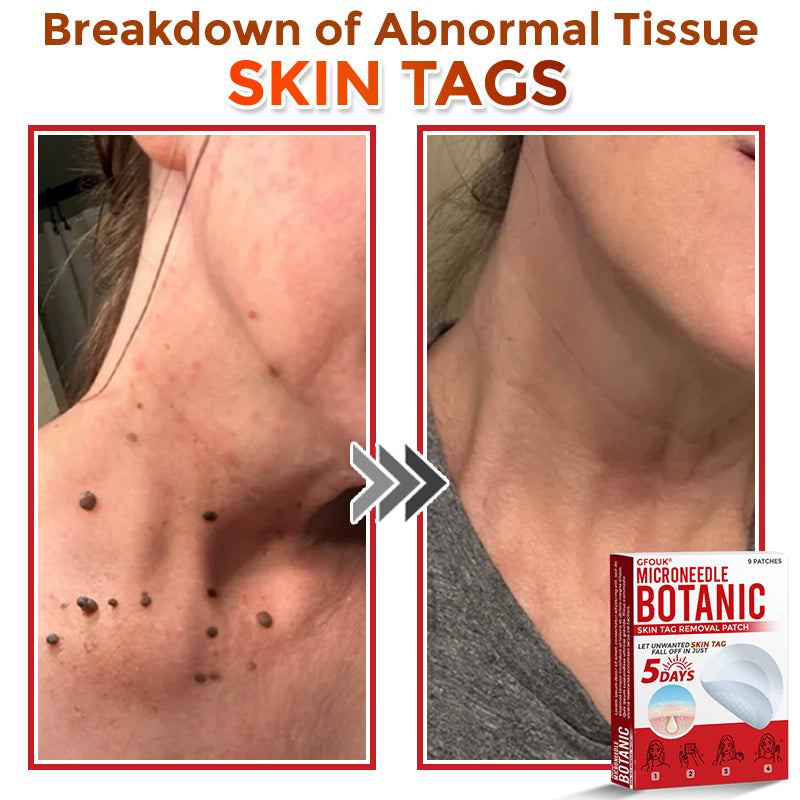 GFOUK® MicroNeedle Botanic Skin Tag Removal Patch 🇨🇦 Made in Canada