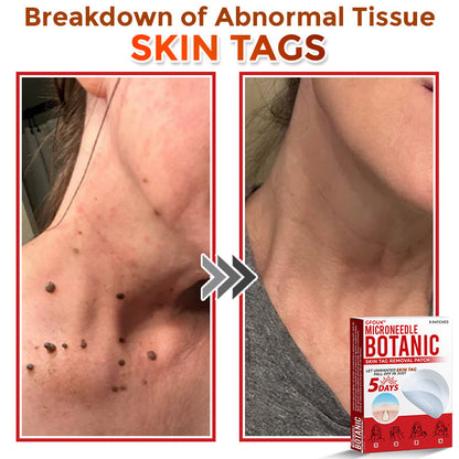 GFOUK® MicroNeedle Botanic Skin Tag Removal Patch 🇨🇦 Made in Canada