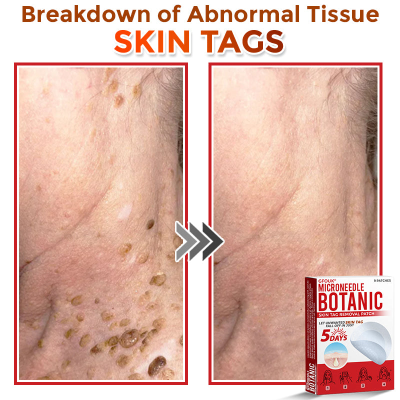 GFOUK® MicroNeedle Botanic Skin Tag Removal Patch 🇨🇦 Made in Canada