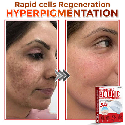 GFOUK® MicroNeedle Botanic Skin Tag Removal Patch 🇨🇦 Made in Canada
