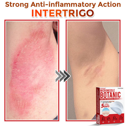 GFOUK® MicroNeedle Botanic Skin Tag Removal Patch 🇨🇦 Made in Canada 🥼👑
