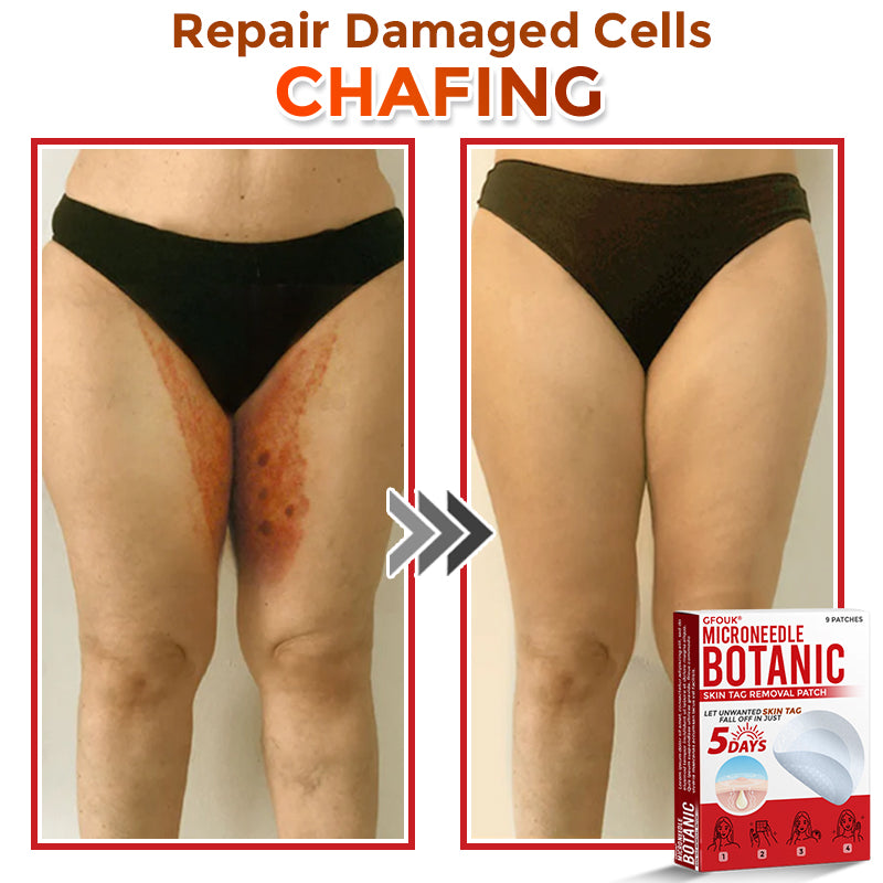 GFOUK® MicroNeedle Botanic Skin Tag Removal Patch 🇨🇦 Made in Canada