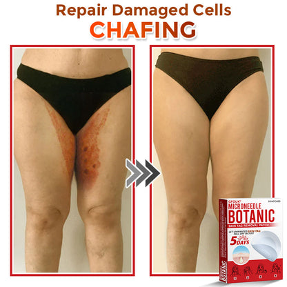 GFOUK® MicroNeedle Botanic Skin Tag Removal Patch 🇨🇦 Made in Canada