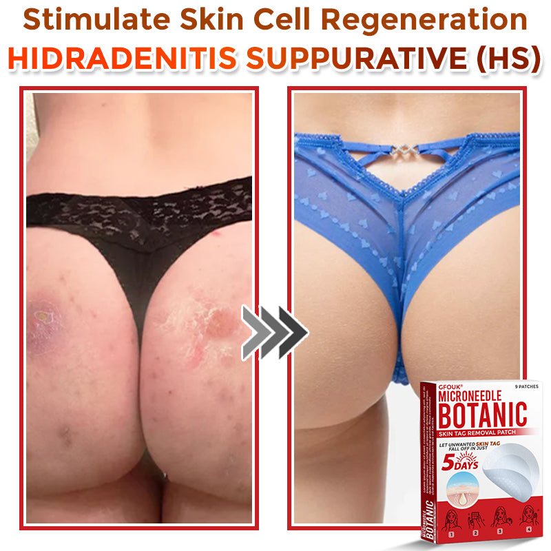 GFOUK® MicroNeedle Botanic Skin Tag Removal Patch 🇨🇦 Made in Canada 🥼👑