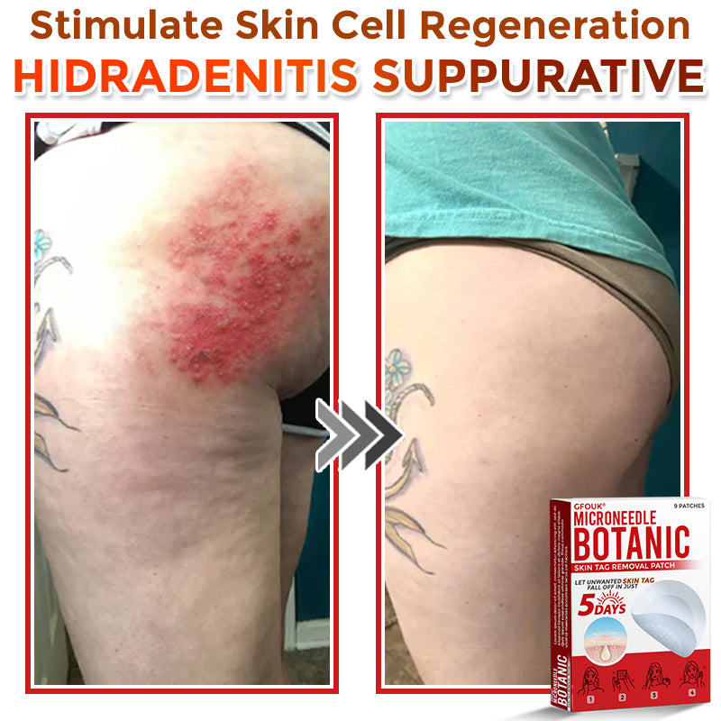 GFOUK® MicroNeedle Botanic Skin Tag Removal Patch 🇨🇦 Made in Canada 🥼👑