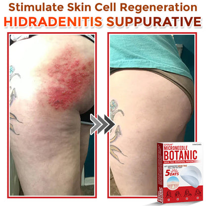 GFOUK® MicroNeedle Botanic Skin Tag Removal Patch 🇨🇦 Made in Canada 🥼👑