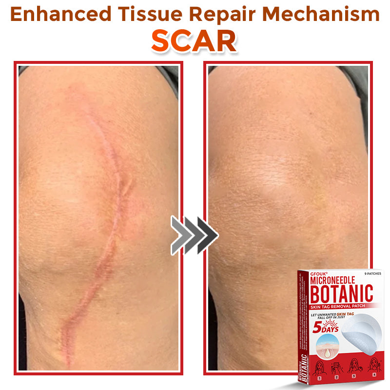 GFOUK® MicroNeedle Botanic Skin Tag Removal Patch 🇨🇦 Made in Canada